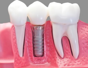 (Español) Implantes Dentales
