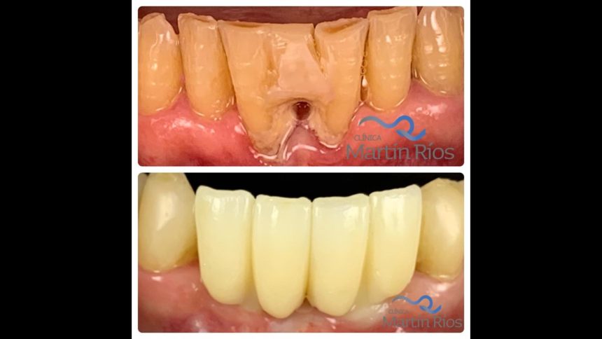 Rehabilitación de dientes antero-inferiores con implantes dentales y puente de zirconio sobre implantes.